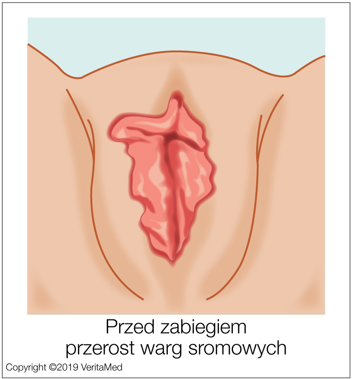 Labioplastyka - PRZED ZABIEGIEM closeup - przerost warg sromowych - VeritaMed.jpg